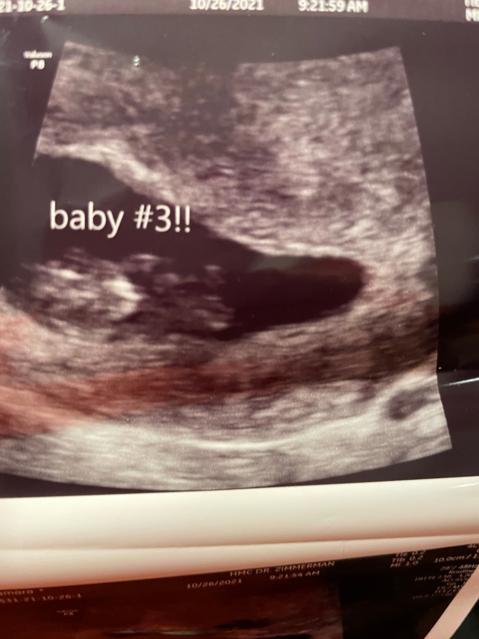 Surrogacy/ miscarried in dec2021., photo 1 of 2