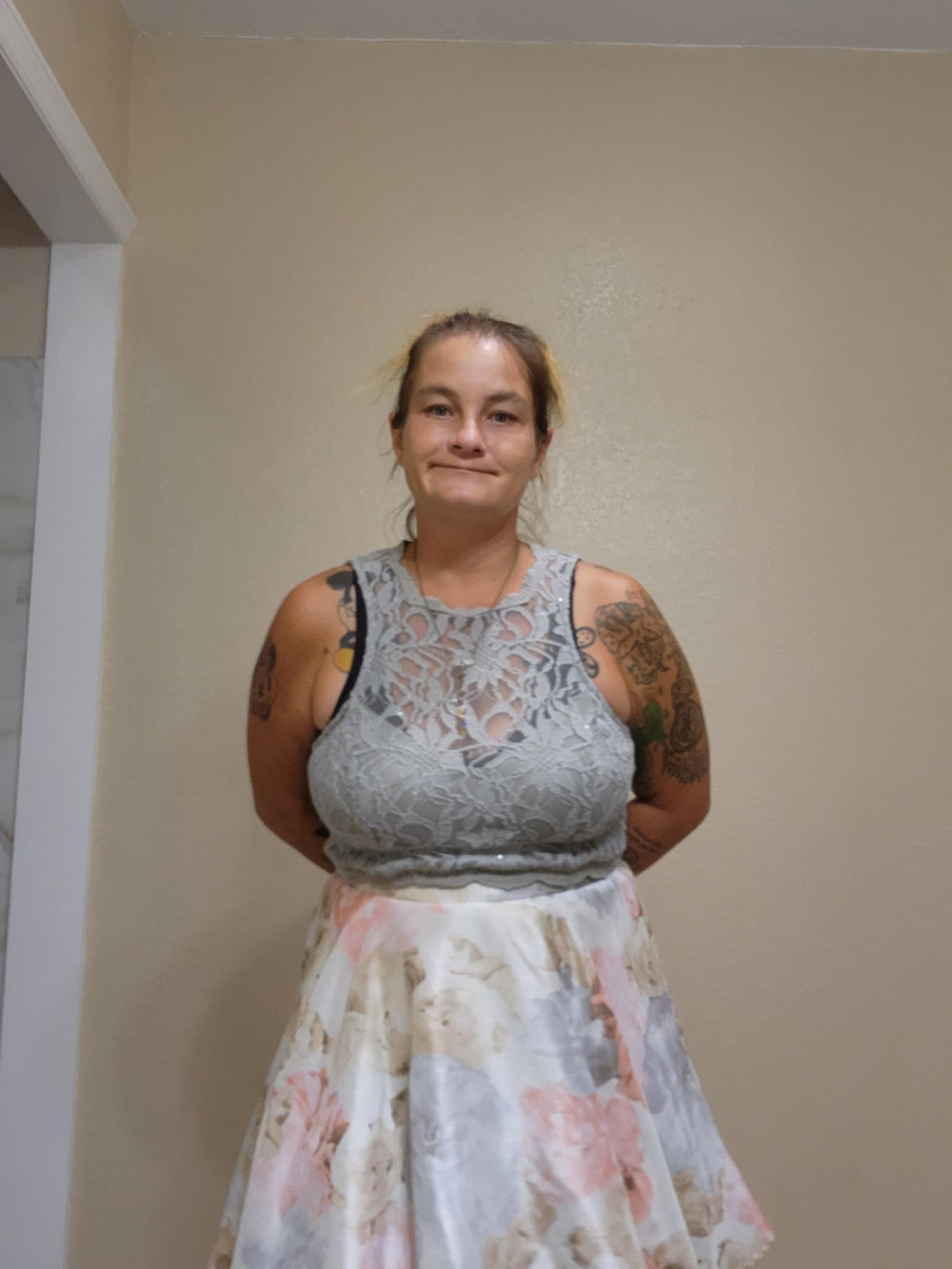 Tubal reversal, photo 1 of 1
