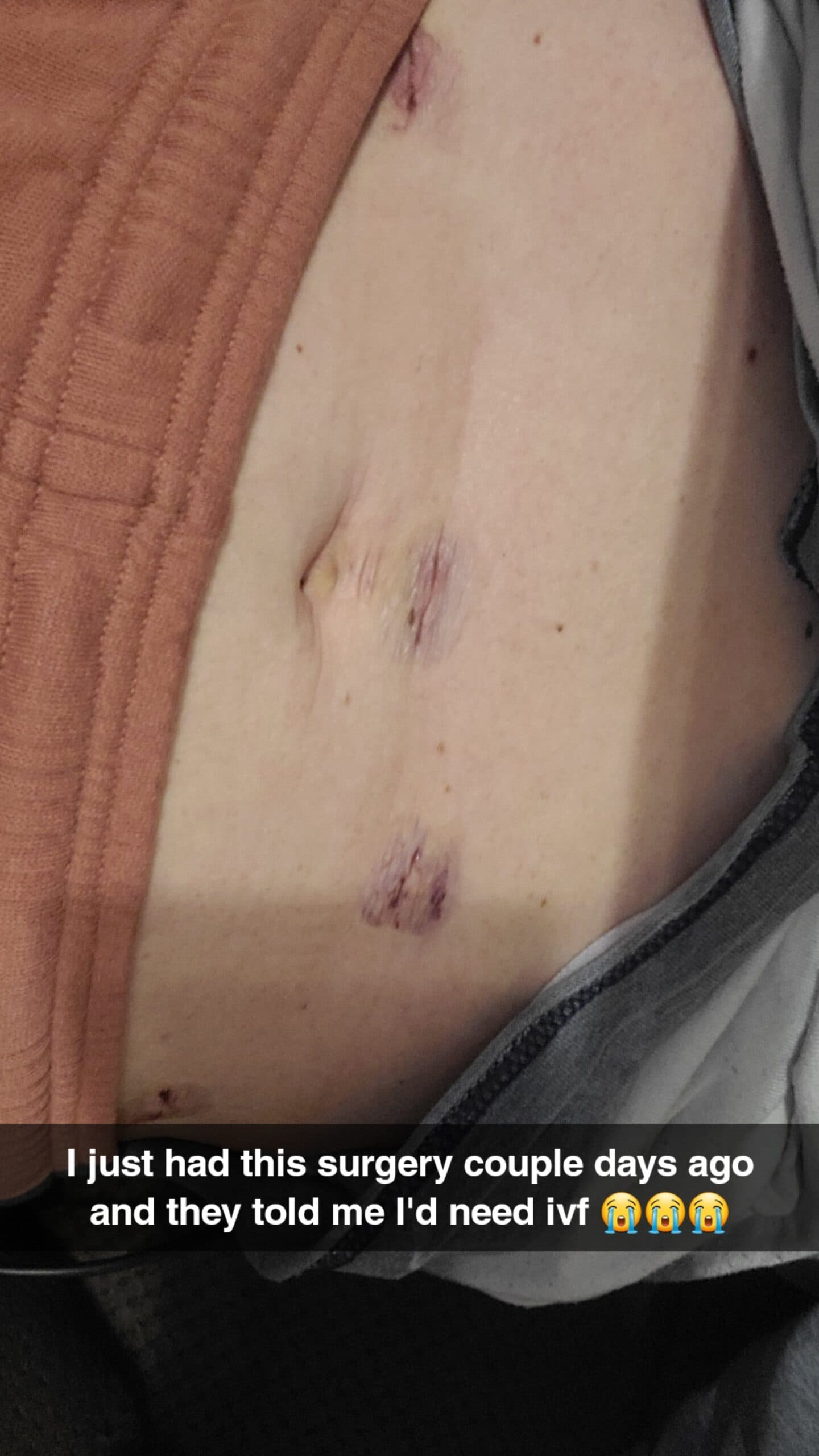 Endometriosis, blocked tubes, photo 1 of 1