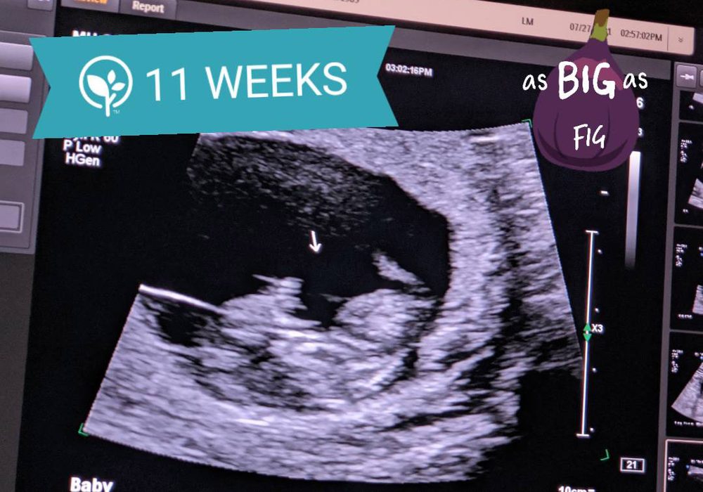 Megan and Tom's 11-week ultrasound photo